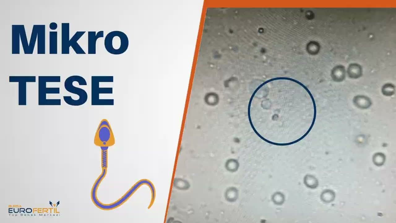 ميكرو تيسي (Micro-TESE)